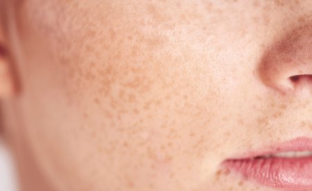 Piel alípica: qué es, en qué se diferencia de la piel seca y cómo mejorarla