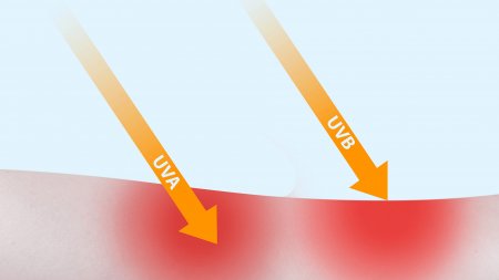 Gráfico quemaduras de sol en la piel