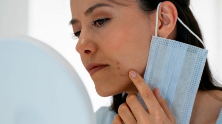 Maskné, mujer con granos en la barbilla por la mascarilla