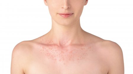 Redness on the chest, one of sun allergies symptoms.