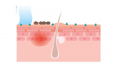 graphic representation of the cleansing effect of anti-acne cleansing products on dirt, perspiration and the effects of pollution