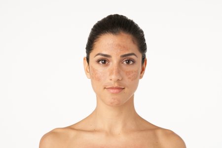 Hyperpigmented skin due to melasma