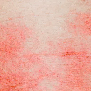 Eczema en la piel
