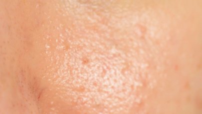Médula ósea Citar clima El sebo, el problema n.°1 de la piel con acné | Sébium | BIODERMA