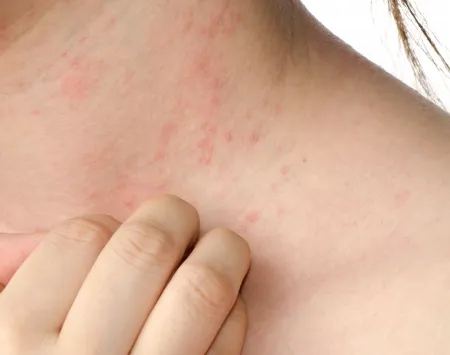 Eczema on the neck